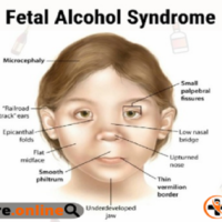 Fetal Alcohol Syndrome In Adults: Meaning, Causes And Treatment