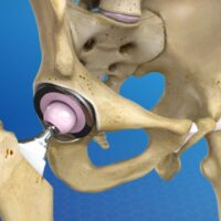 A Guide to the Different Types of Hip Replacement Surgeries, In Tanzania